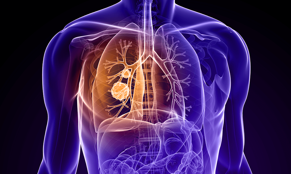 medical-oncologist-in-bangalore-lung-cancer