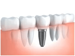 best implant dentist in Ahmedabad