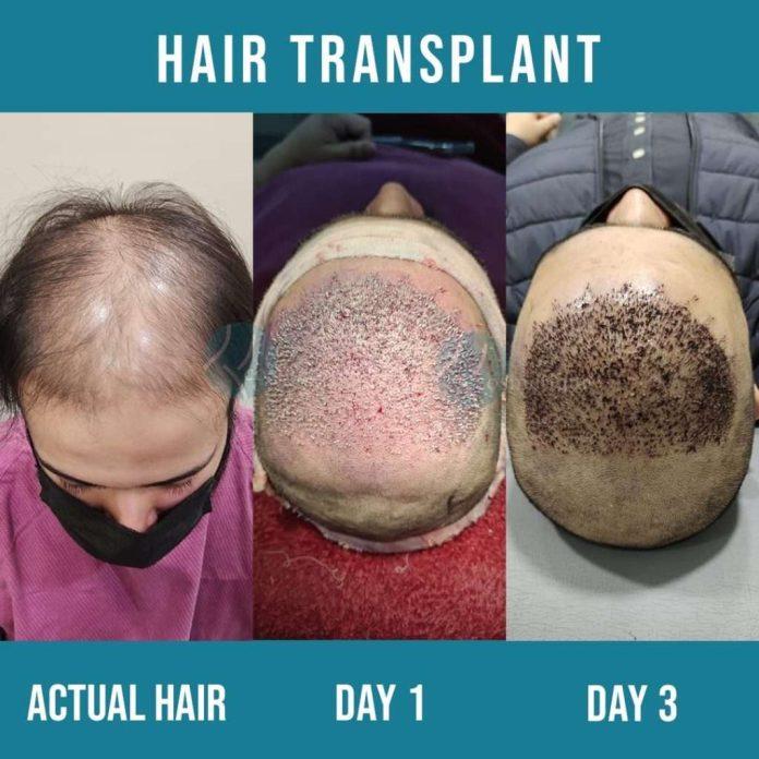 Hair transplant in Lahore