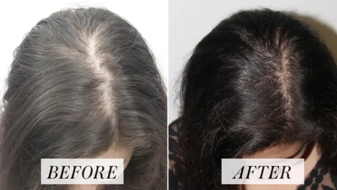 platelet rich plasma hair loss treatment New Jersey