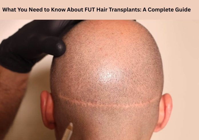 What You Need to Know About FUT Hair Transplants: A Complete Guide