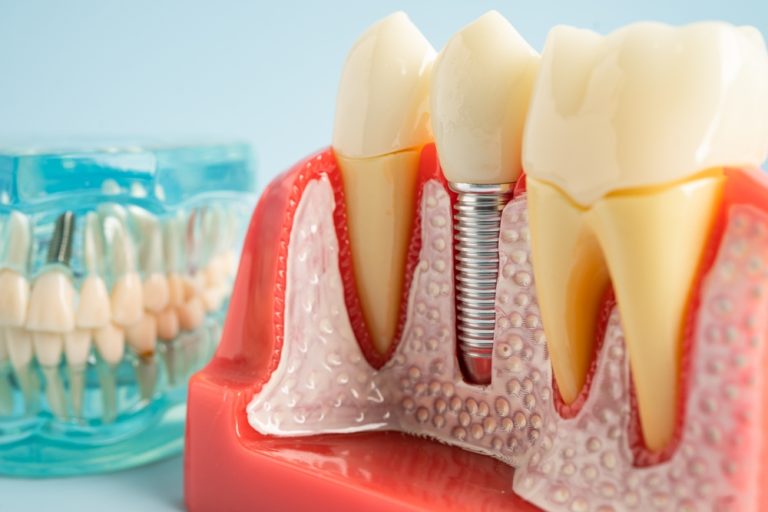 Dental Implants vs. Dentures: Understanding Your Tooth Replacement Options