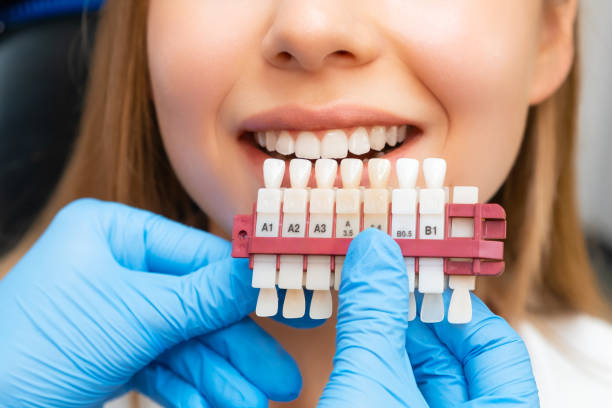 are veneers bad for your natural teeth