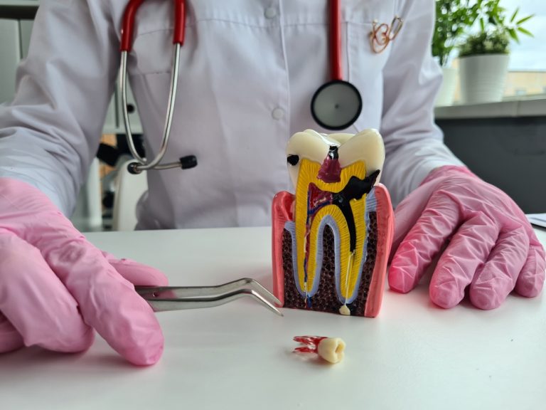 root canal vs tooth extraction choosing the right option in burnaby