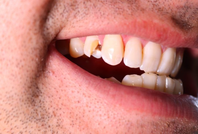 how quickly should you act if a permanent tooth gets knocked out