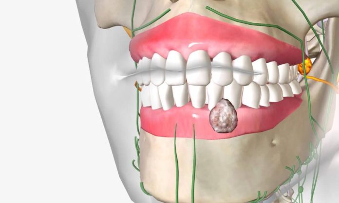 oral cancer in reed deer, alberta