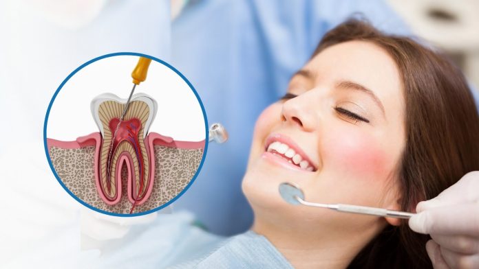 root canal cost richmond