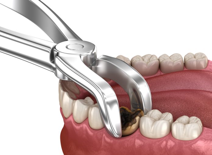 When Is Tooth Extraction Necessary? Signs & Reasons Explained