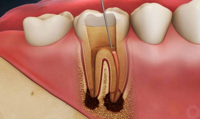 what to expect during root canal treatment near you