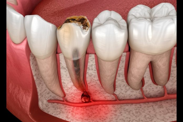 root canal treatment in red deer