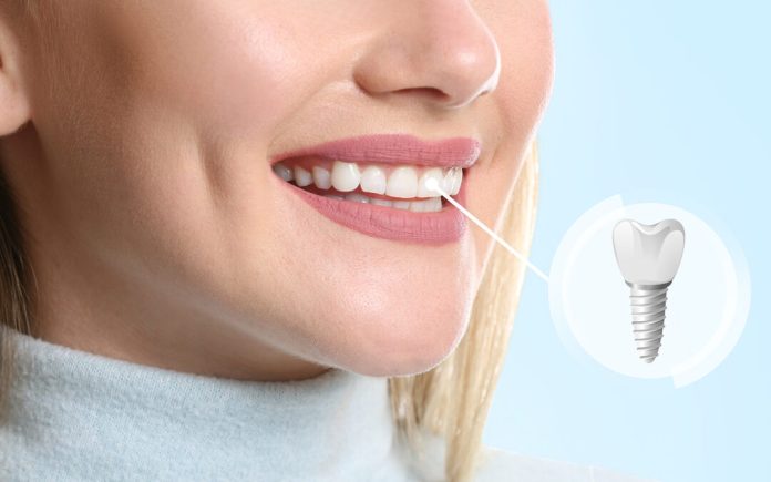 are dental implants a good option for older adults