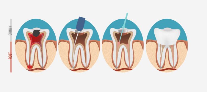 what is a root canal and why might you need one