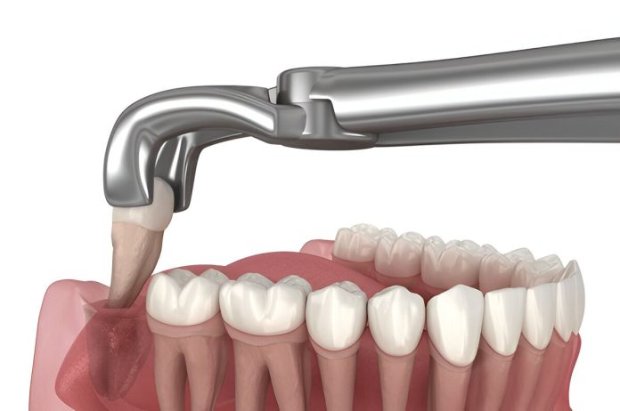 wisdom-tooth-extractions