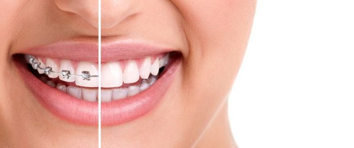 angel-aligners-in-morton-grove