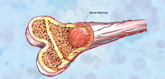 bone marrow transplantation procedure